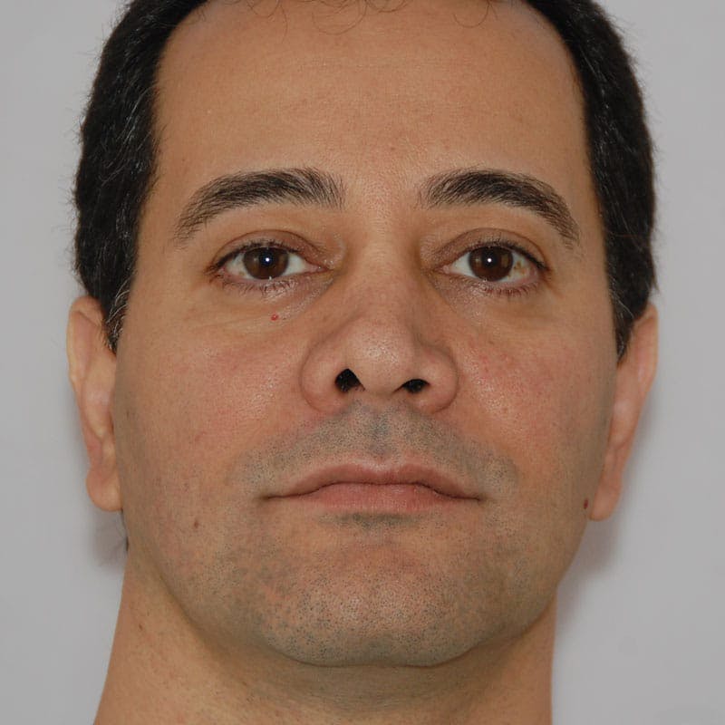 Revision Rhinoplasty Before & After Gallery - Patient 617931 - Image 3