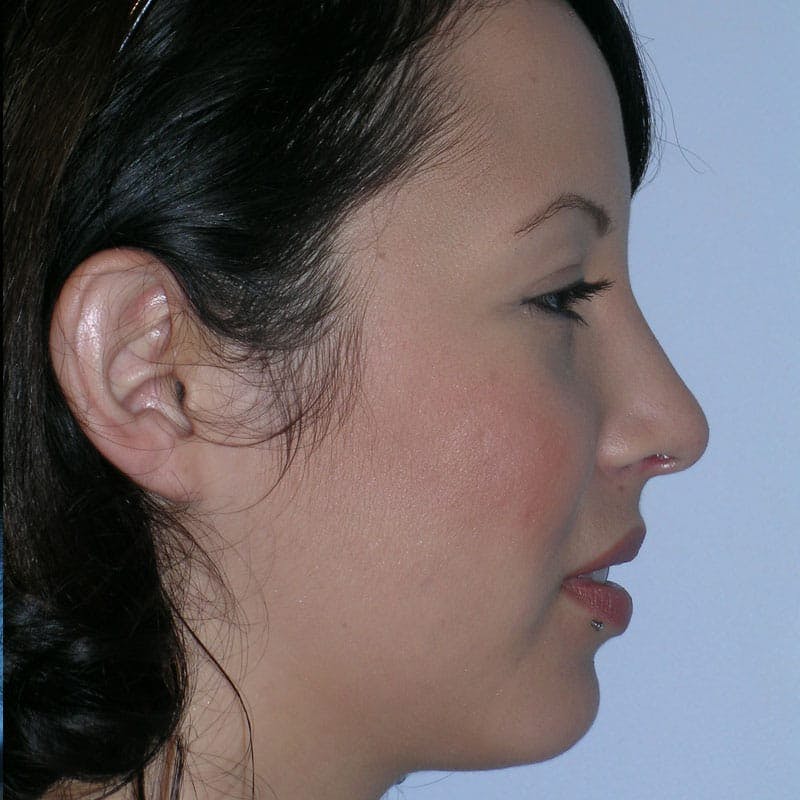 Small Changes Before & After Gallery - Patient 958037 - Image 6