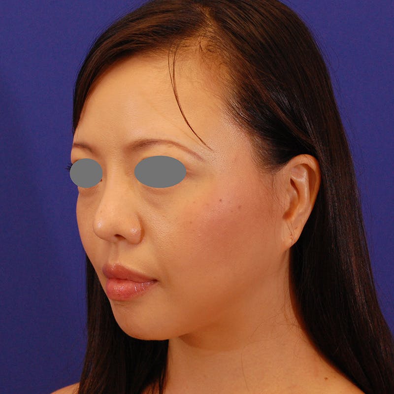 Revision Rhinoplasty Before & After Gallery - Patient 654727 - Image 5