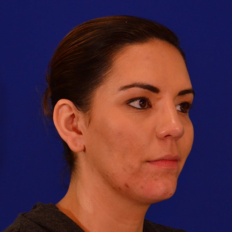 Chin Augmentation Before & After Gallery - Patient 287872 - Image 4