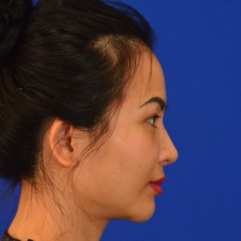 Revision Rhinoplasty Before & After Gallery - Patient 132405 - Image 2