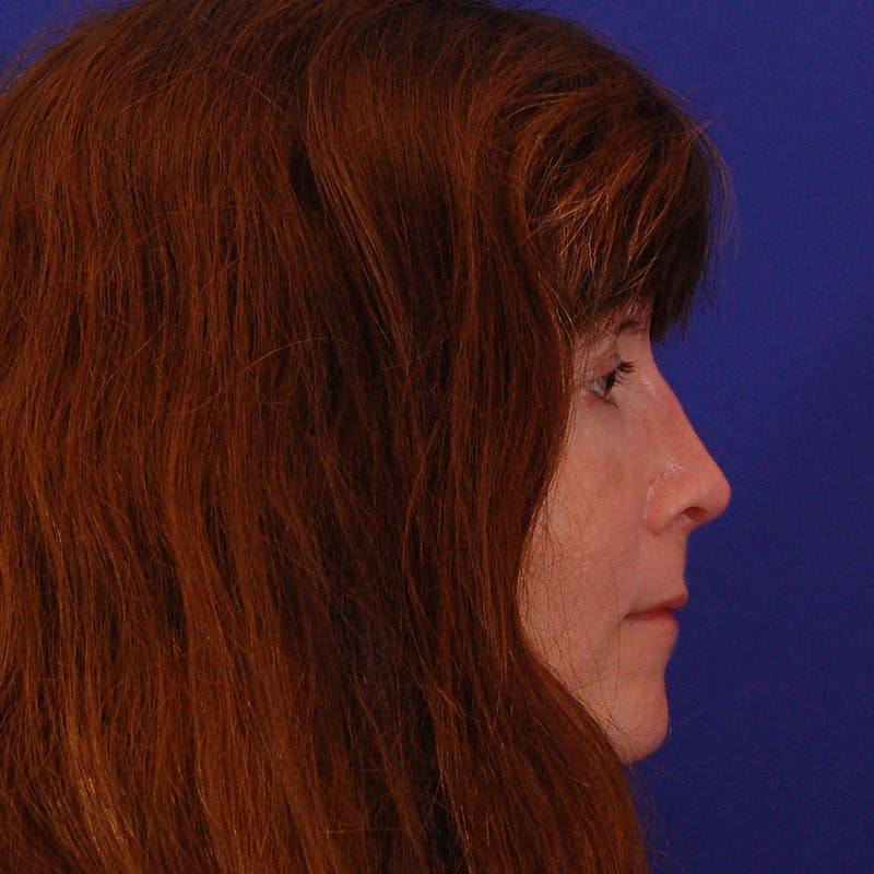 Revision Rhinoplasty Before & After Gallery - Patient 410283 - Image 2