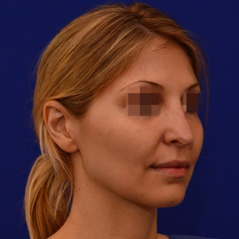 Revision Rhinoplasty Before & After Gallery - Patient 279186 - Image 9
