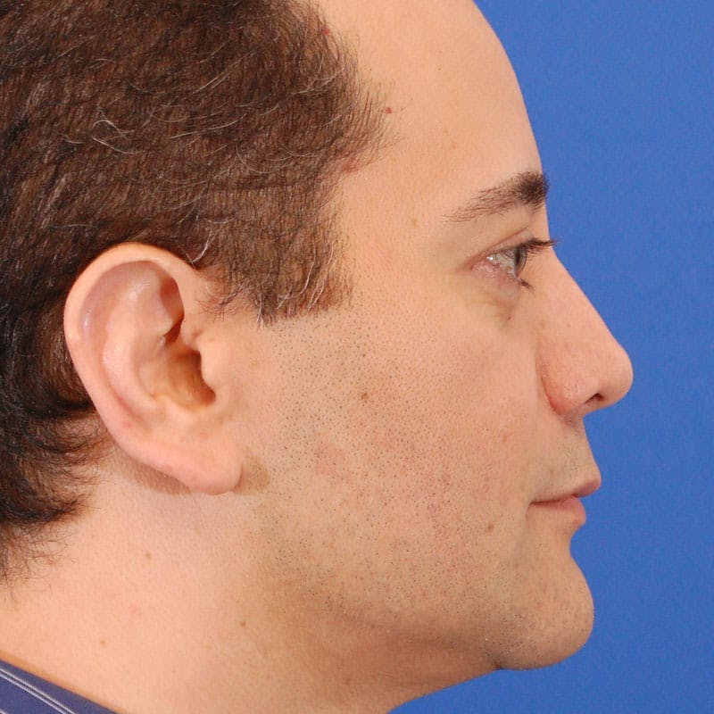 Revision Rhinoplasty Before & After Gallery - Patient 617931 - Image 2
