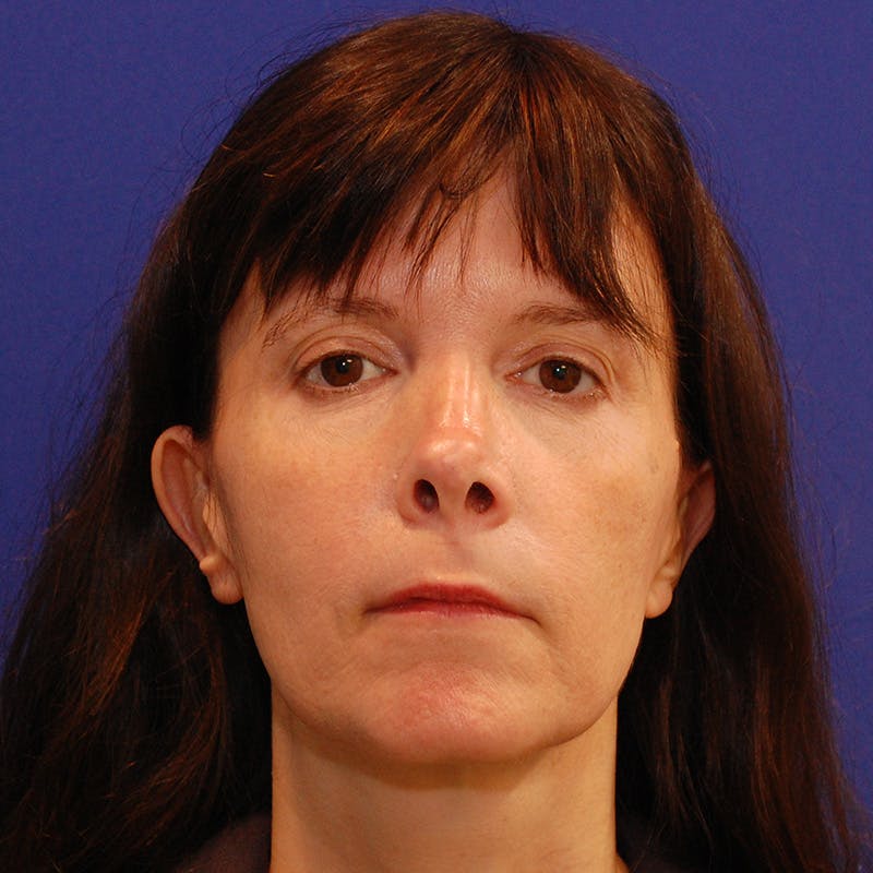 Revision Rhinoplasty Before & After Gallery - Patient 410283 - Image 5