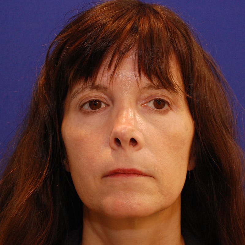 Revision Rhinoplasty Before & After Gallery - Patient 410283 - Image 6