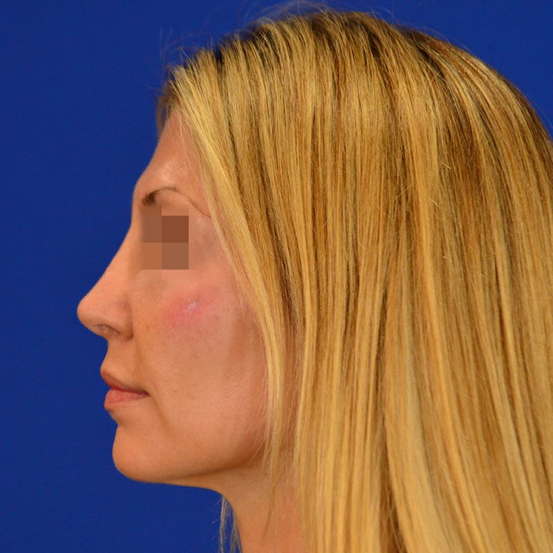 Revision Rhinoplasty Before & After Gallery - Patient 279186 - Image 4