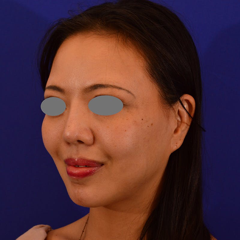 Revision Rhinoplasty Before & After Gallery - Patient 654727 - Image 6