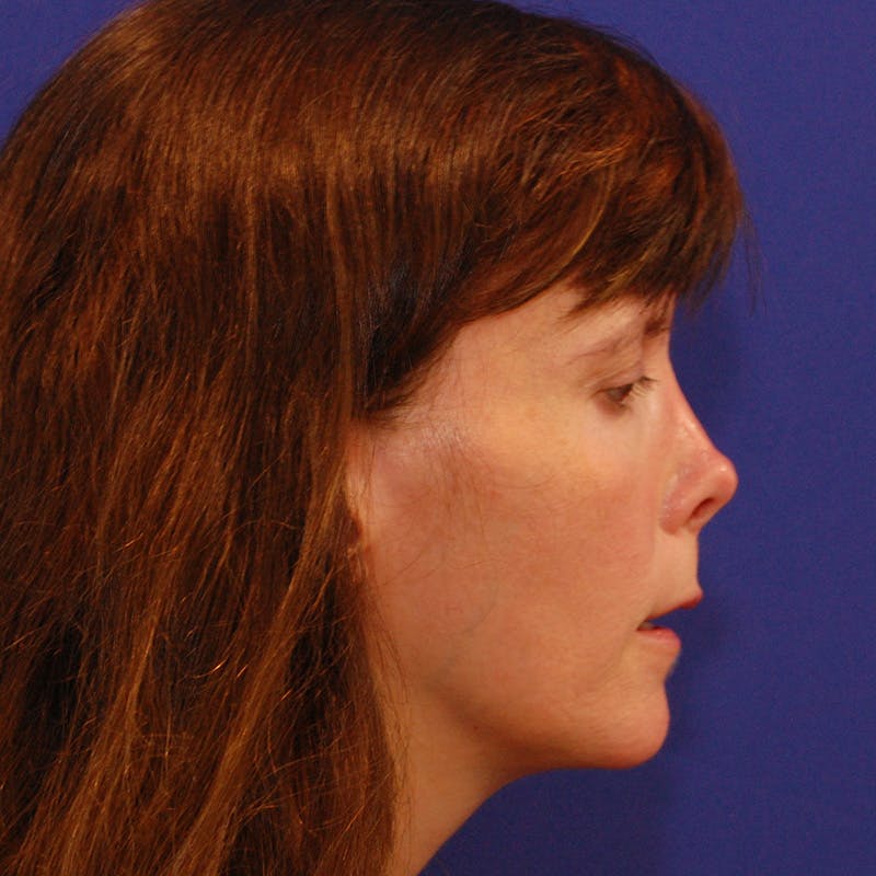 Revision Rhinoplasty Before & After Gallery - Patient 410283 - Image 1