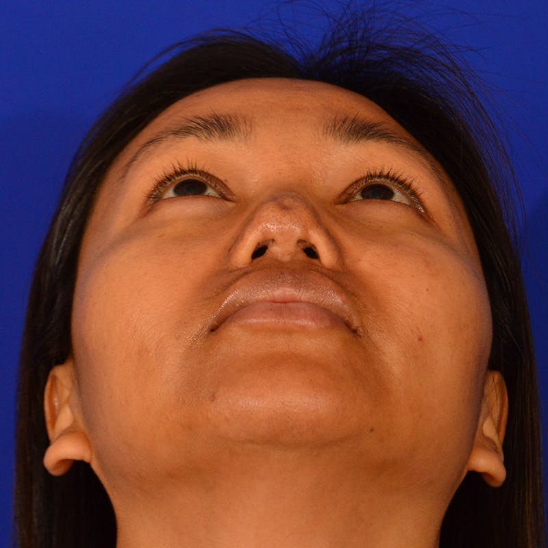 Revision Rhinoplasty Before & After Gallery - Patient 235432 - Image 11
