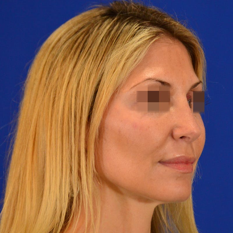 Revision Rhinoplasty Before & After Gallery - Patient 279186 - Image 10