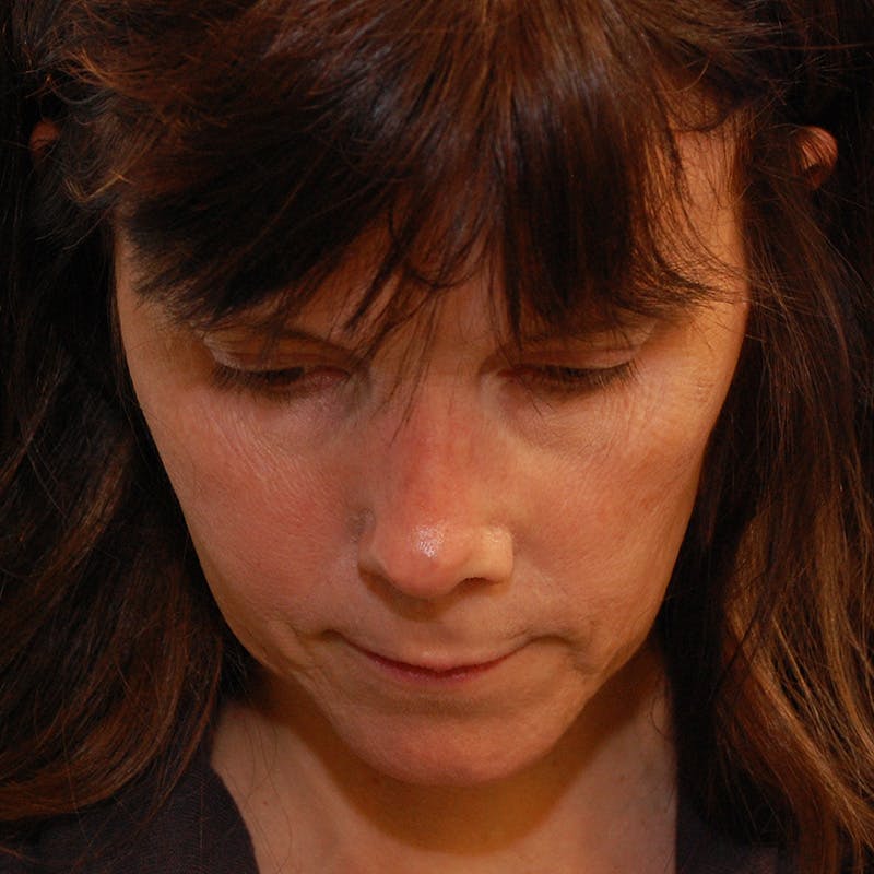 Revision Rhinoplasty Before & After Gallery - Patient 410283 - Image 11