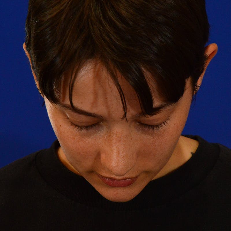 Revision Rhinoplasty Before & After Gallery - Patient 137431 - Image 14