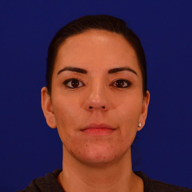 Chin Augmentation Before & After Gallery - Patient 287872 - Image 2