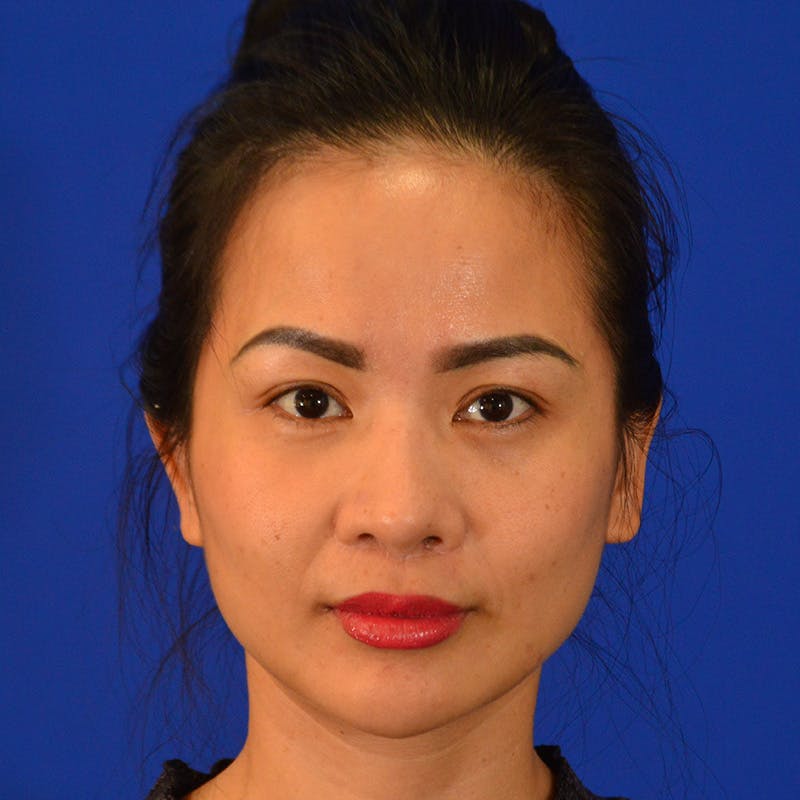Revision Rhinoplasty Before & After Gallery - Patient 132405 - Image 6