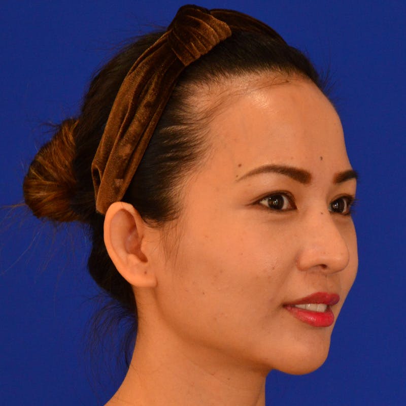 Revision Rhinoplasty Before & After Gallery - Patient 132405 - Image 3