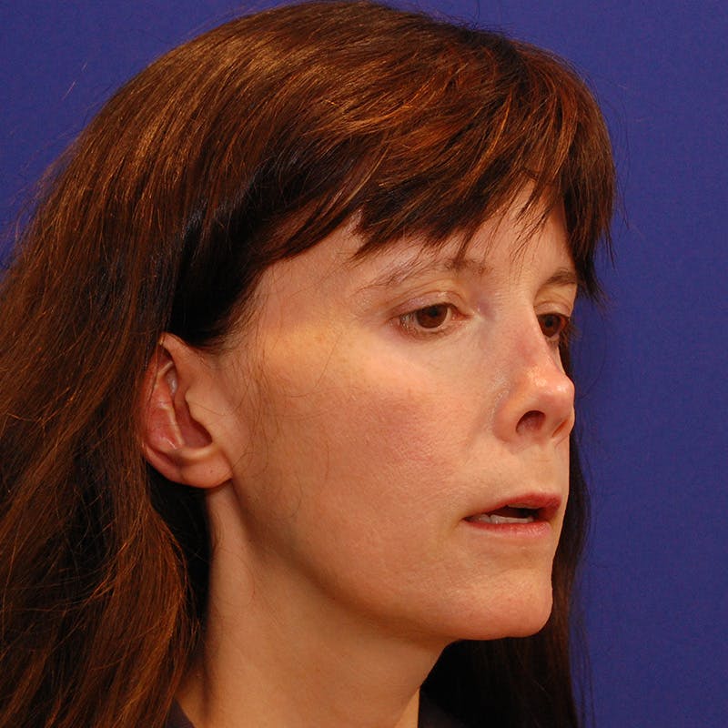 Revision Rhinoplasty Before & After Gallery - Patient 410283 - Image 3