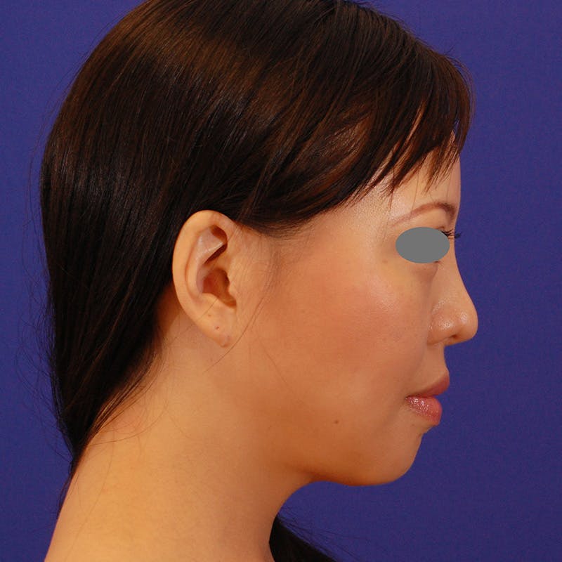Revision Rhinoplasty Before & After Gallery - Patient 654727 - Image 1