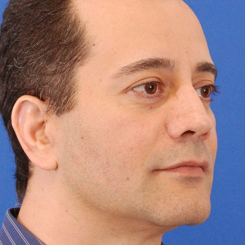Revision Rhinoplasty Before & After Gallery - Patient 617931 - Image 6