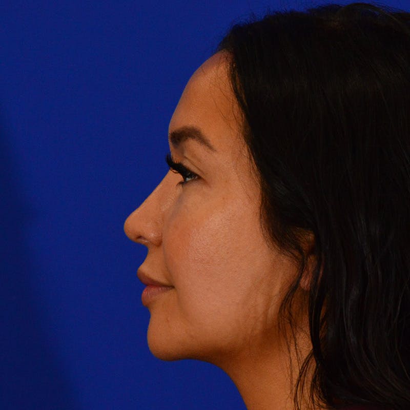 Wide Nose Before & After Gallery - Patient 758815 - Image 10