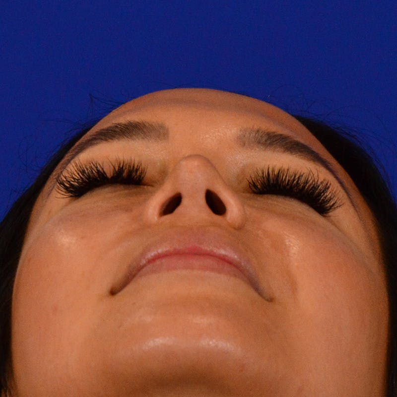 Wide Nose Before & After Gallery - Patient 758815 - Image 12