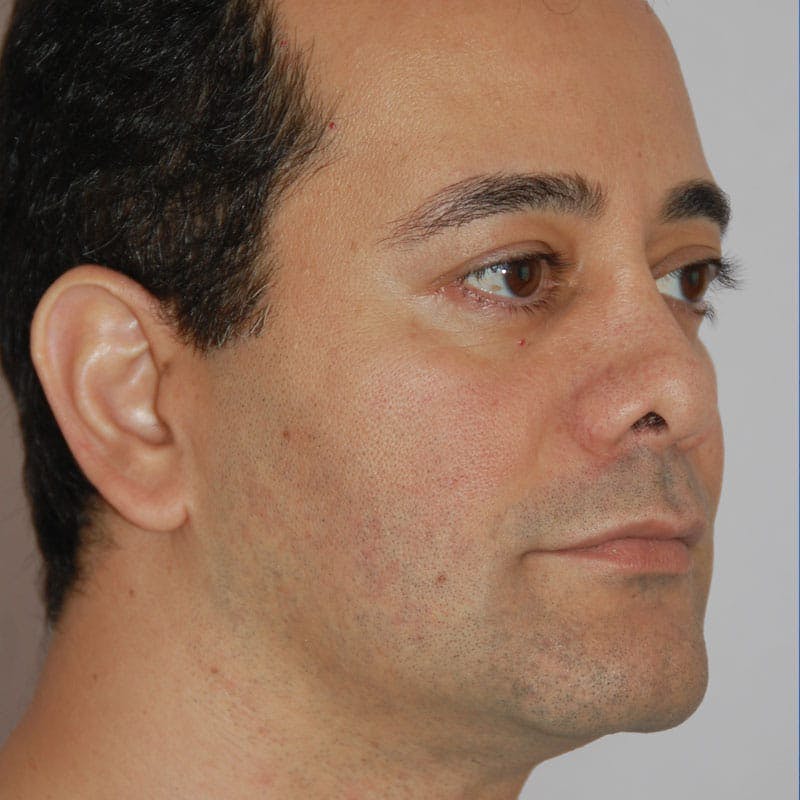 Revision Rhinoplasty Before & After Gallery - Patient 617931 - Image 5