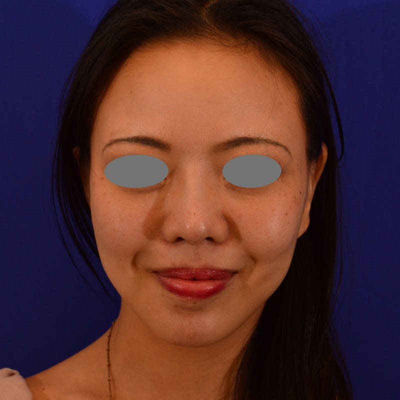 Revision Rhinoplasty Before & After Gallery - Patient 654727 - Image 4