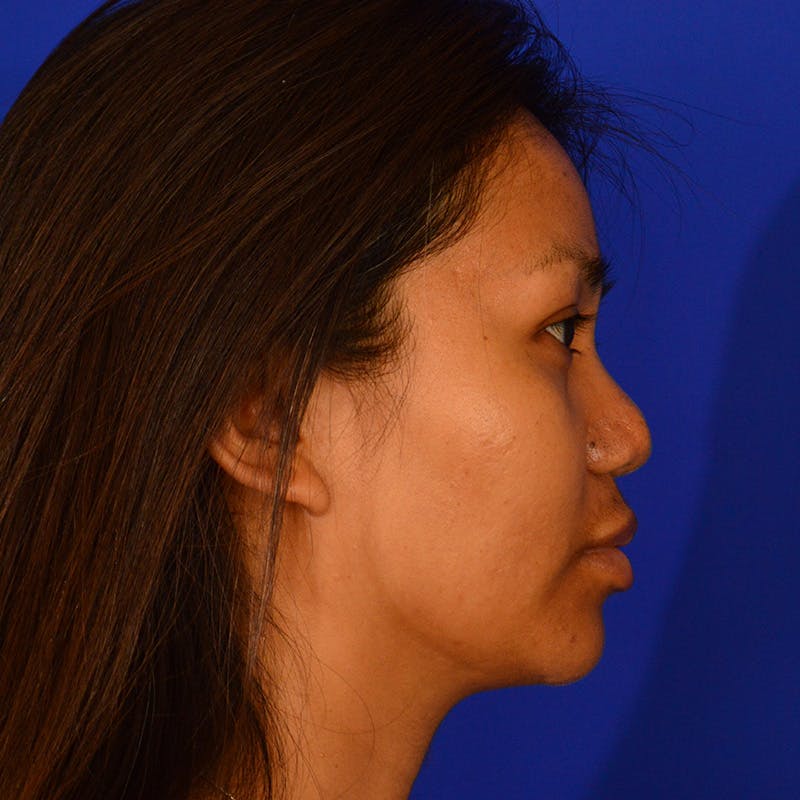 Revision Rhinoplasty Before & After Gallery - Patient 235432 - Image 1