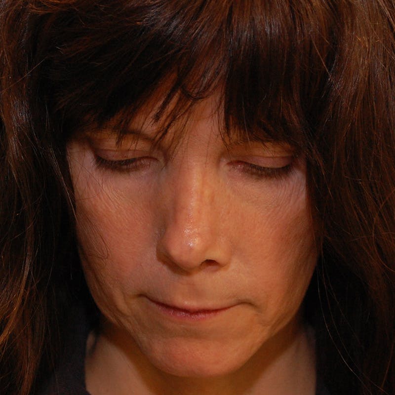 Revision Rhinoplasty Before & After Gallery - Patient 410283 - Image 12