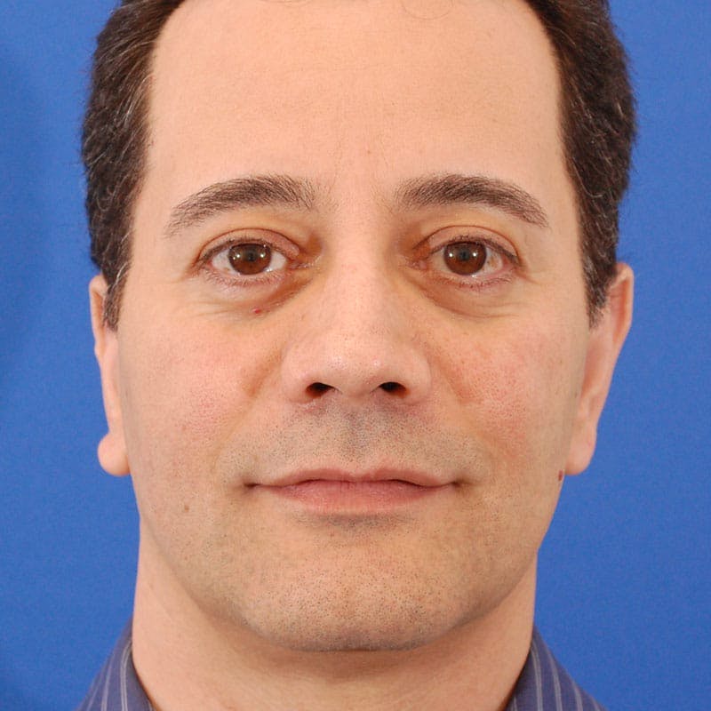 Revision Rhinoplasty Before & After Gallery - Patient 617931 - Image 4