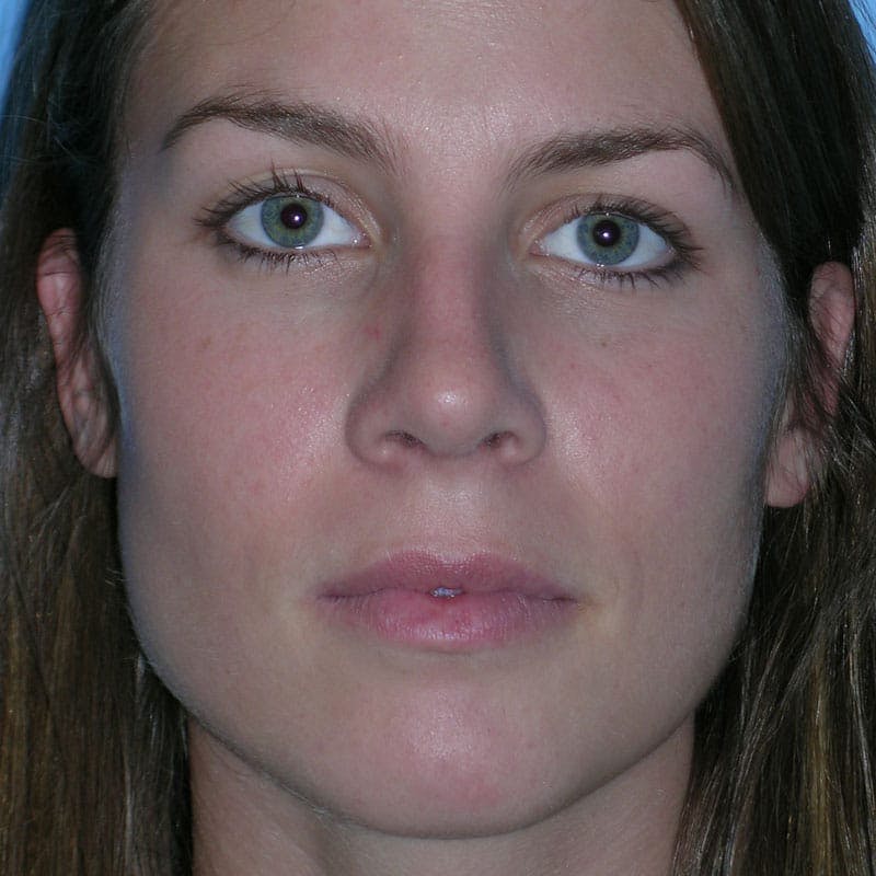 Wide Nose Before & After Gallery - Patient 778796 - Image 2