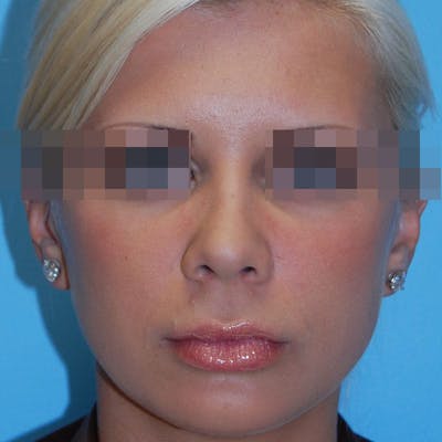 Wide Nose Before & After Gallery - Patient 927911 - Image 2