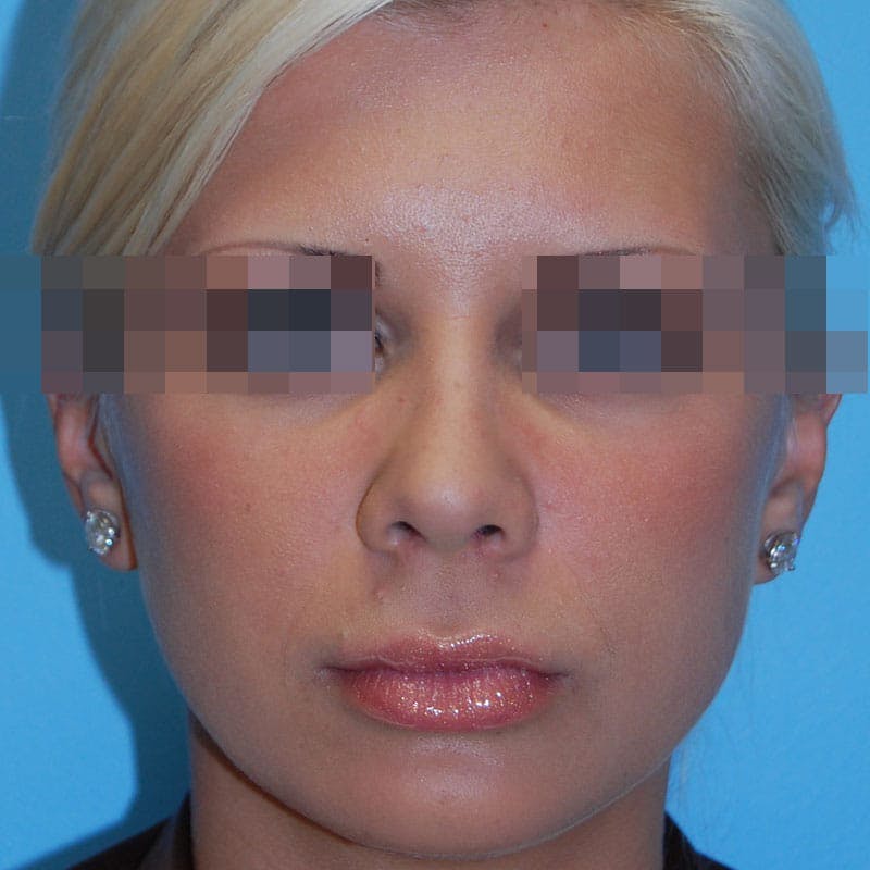 Wide Nose Before & After Gallery - Patient 927911 - Image 2