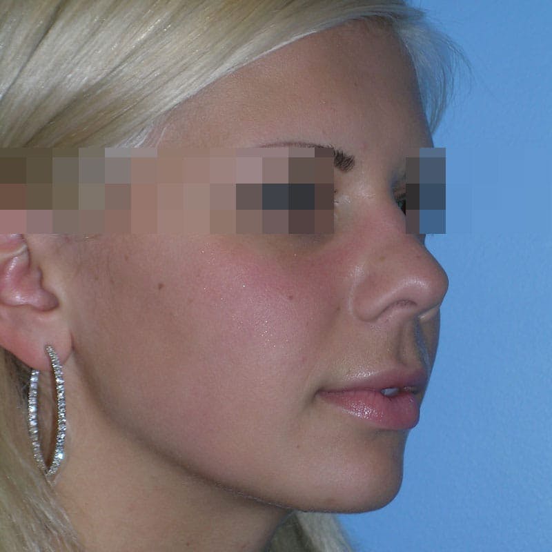 Wide Nose Before & After Gallery - Patient 927911 - Image 3