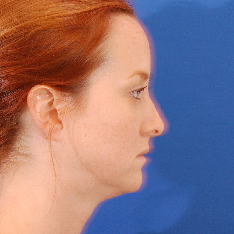 Revision Rhinoplasty Before & After Gallery - Patient 398239 - Image 3