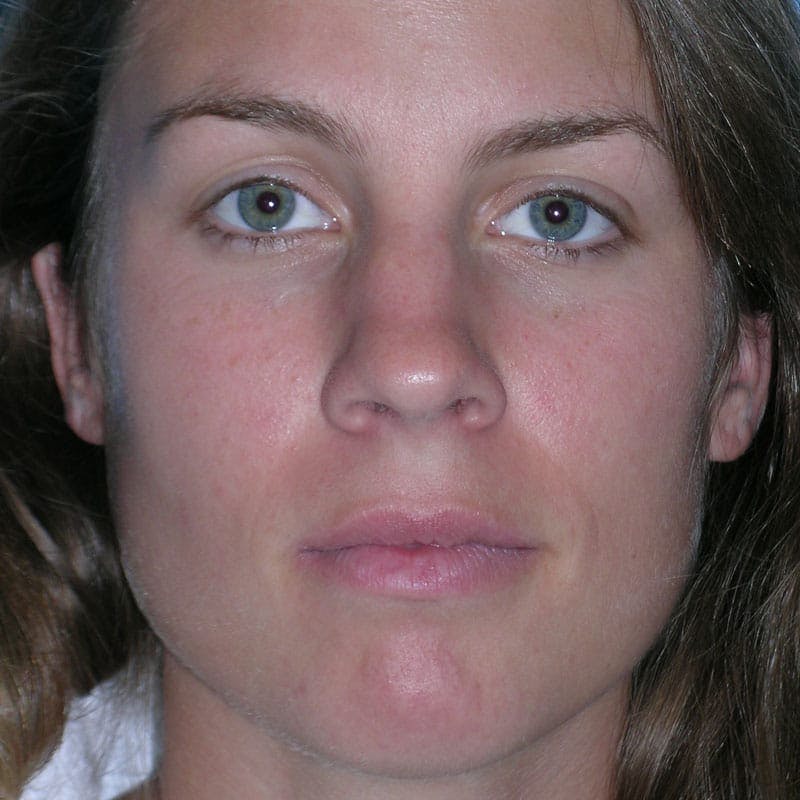Wide Nose Before & After Gallery - Patient 778796 - Image 1