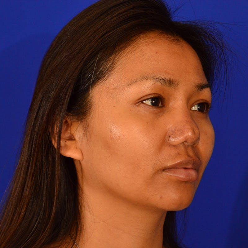 Revision Rhinoplasty Before & After Gallery - Patient 235432 - Image 3