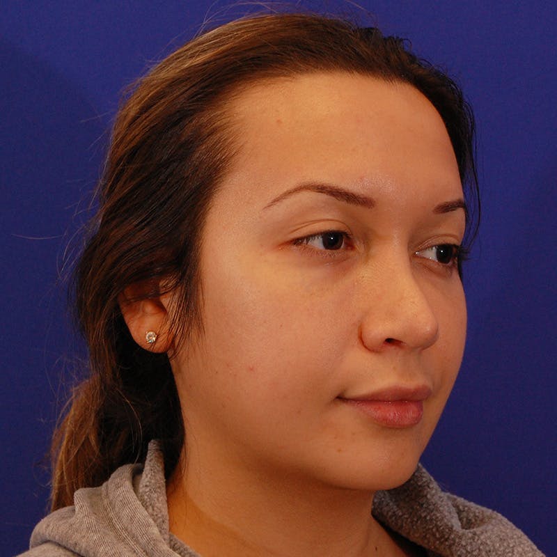 Wide Nose Before & After Gallery - Patient 758815 - Image 3