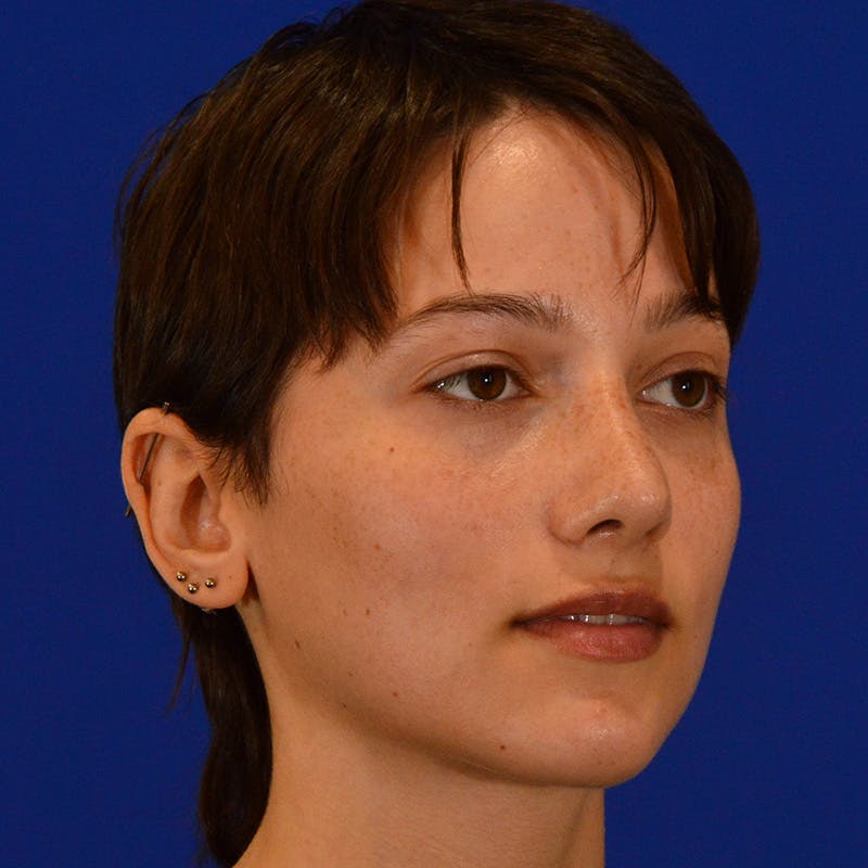 Revision Rhinoplasty Before & After Gallery - Patient 137431 - Image 4