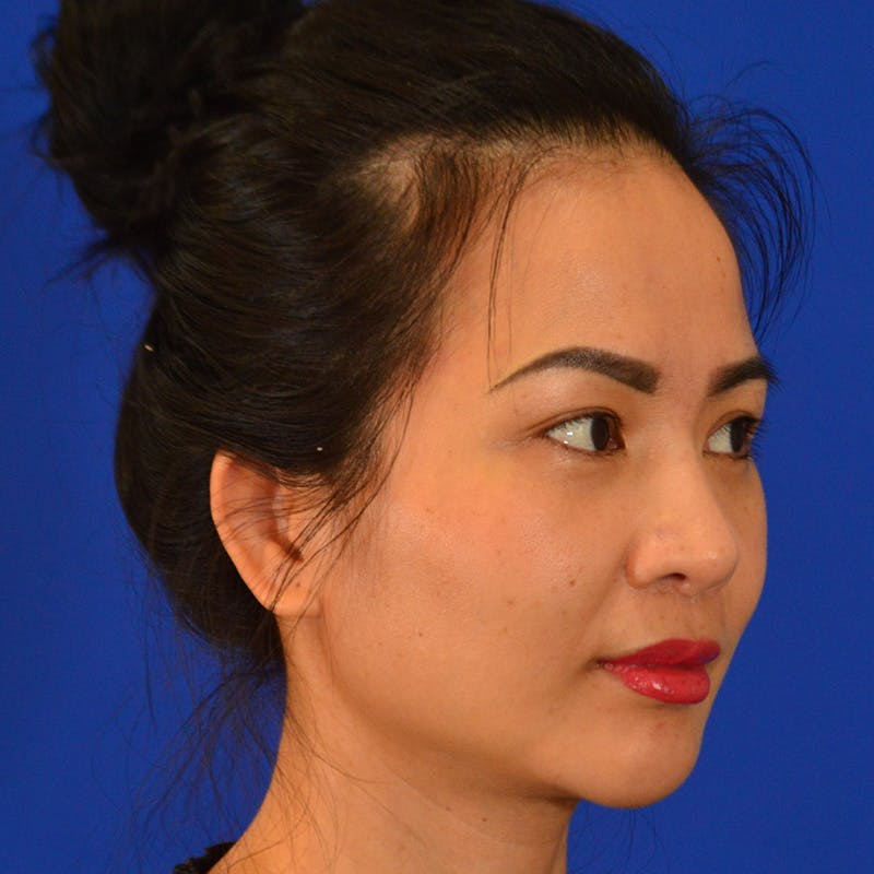 Revision Rhinoplasty Before & After Gallery - Patient 132405 - Image 4