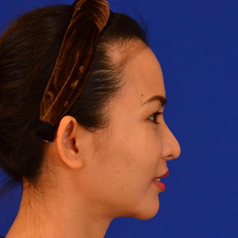 Revision Rhinoplasty Before & After Gallery - Patient 132405 - Image 1