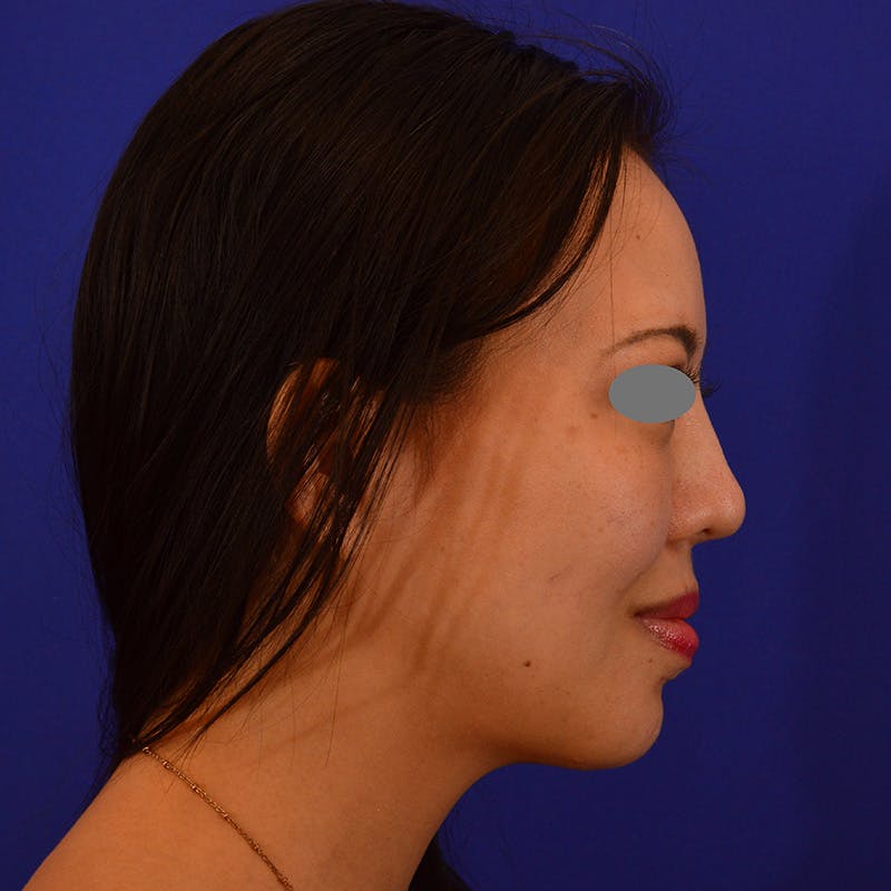 Revision Rhinoplasty Before & After Gallery - Patient 654727 - Image 2