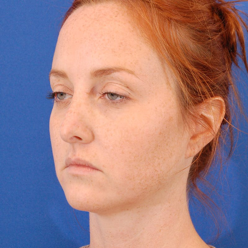Revision Rhinoplasty Before & After Gallery - Patient 398239 - Image 9