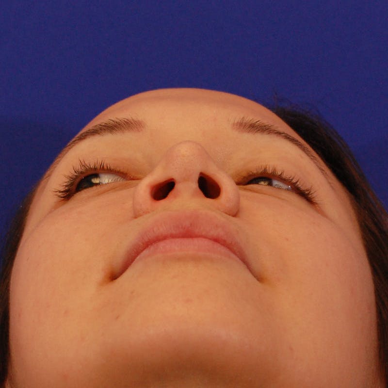 Wide Nose Before & After Gallery - Patient 758815 - Image 11