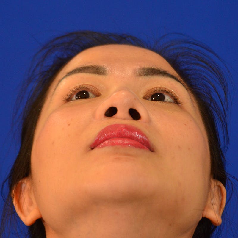Revision Rhinoplasty Before & After Gallery - Patient 132405 - Image 12