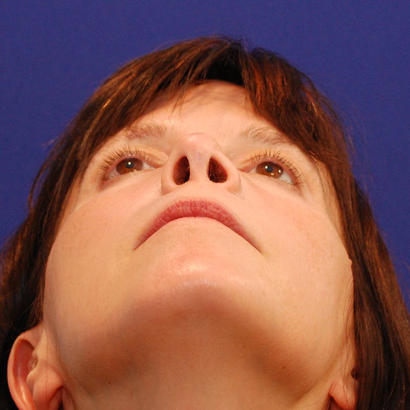 Revision Rhinoplasty Before & After Gallery - Patient 410283 - Image 13