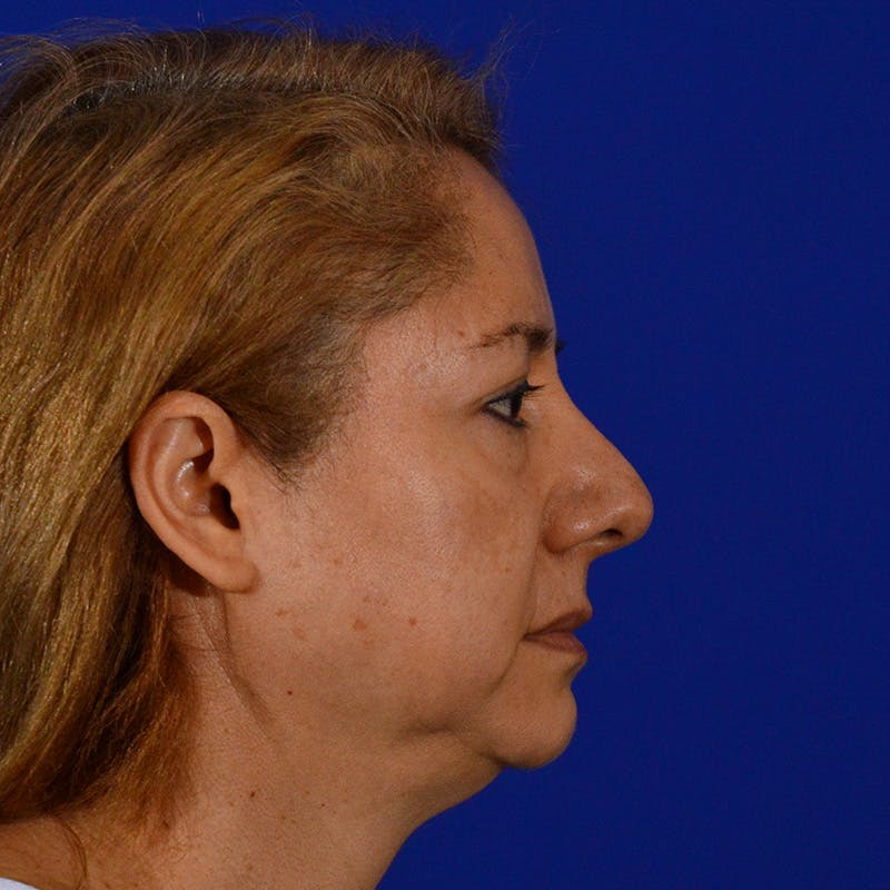 Revision Rhinoplasty Before & After Gallery - Patient 197355 - Image 1