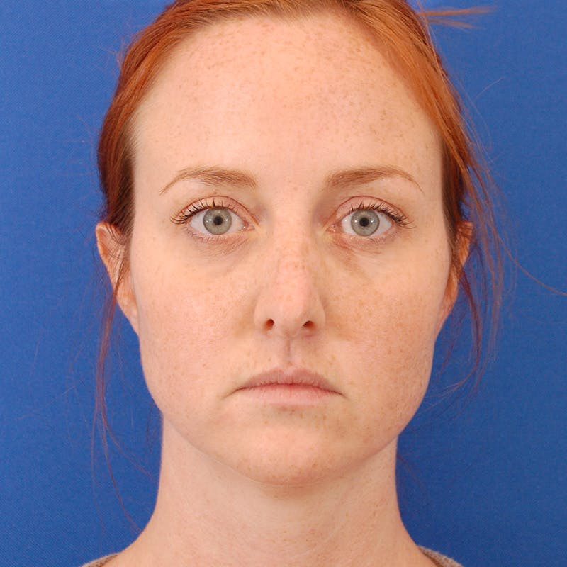 Revision Rhinoplasty Before & After Gallery - Patient 398239 - Image 7