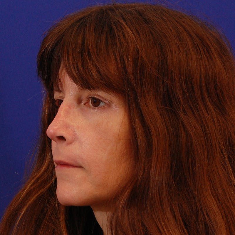 Revision Rhinoplasty Before & After Gallery - Patient 410283 - Image 8