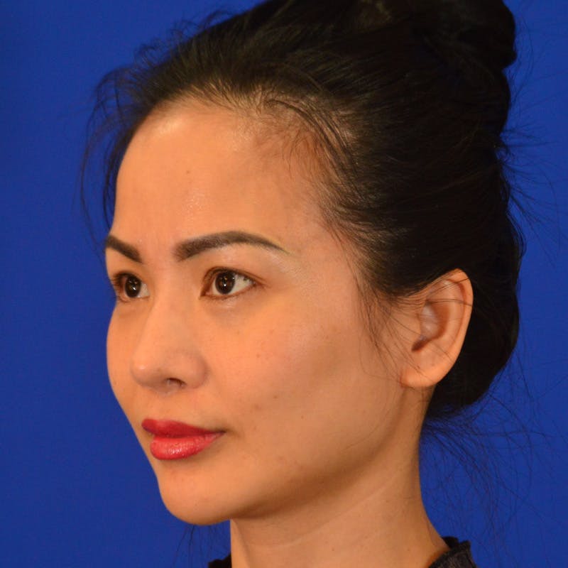 Revision Rhinoplasty Before & After Gallery - Patient 132405 - Image 8